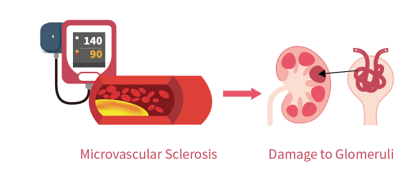 invisible-risk-hypertension-ckd